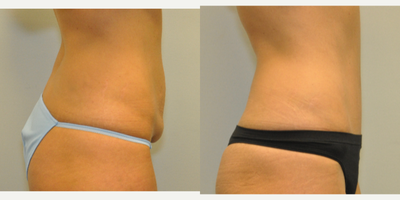 35-44 year old woman treated with Drainless Tummy Tuck - This 43 year old female had a drainless tummy tuck with a progressive tension suture technique and a very low scar.