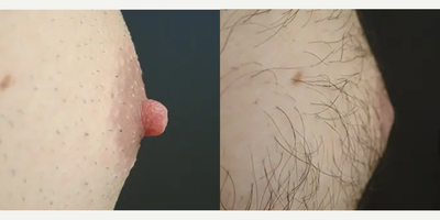 35-44 year old man treated with Nipple Reduction - Age: 39Height: 5'9Post-Op Photos taken at 2 MonthsProcedure: Bilateral Nipple Reduction