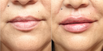 45-54 year old woman treated with Restylane - The patient underwent lip augmentation with Restylane. The filler adds a natural but sexy appearance to her lips. The pictures show her transformation in this twenty minute procedure. Lip enhancement and replenish the volume patients have lost in their lips as we age, or create the lips they have always desired.