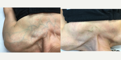 Female Treated with Sclerotherapy / Asclero for Prominent Chest Veins - Before & After 2 sessions of Sclerotherapy for chest veins! The vein will continue to heal and fade completely.