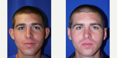 25-34 year old woman treated with Ear Surgery - 25-34 year old woman treated with Ear Surgery