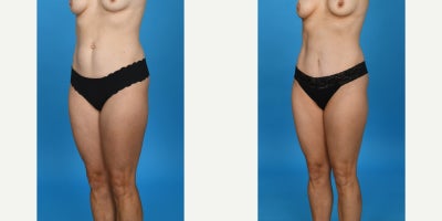 35-44 year old woman treated with Abdominal Etching, Diastasis Recti Repair, Drainless Tummy Tuck, Liposculpture, Liposuction, M - Standard tummy tuck with VASER ultrasound liposuction 360 and corset muscle plication.
