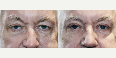 68 year old man treated with Upper Blepharoplasty Surgery - 68 year old man treated with Upper Blepharoplasty Surgery to lift and remove excess skin and other tissues because of vision and cosmetic concerns.