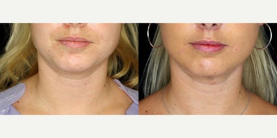 27 year old woman treated with PrecisionTx - 27 year old woman treated with PrecisionTx. Photos depict before and 4 months after surgery.