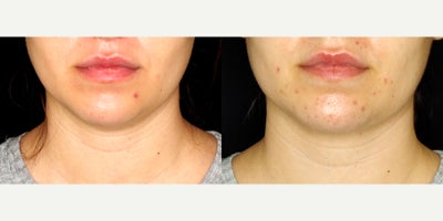 28 year old woman treated with PrecisionTx - 28 year old woman treated with PrecisionTx. Photos depict before and 2 months after surgery.