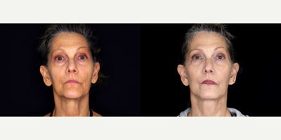 64 year old woman treated with Genioplasty (reduction) and necklift. - 64 year old woman treated with Genioplasty (reduction) and necklift. Photos depict before and 1 month after surgery.