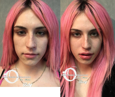 18-24 year old woman treated with Juvederm - 18-24 year old woman treated with Juvederm on thelips