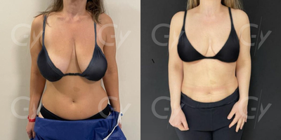 45-54 year old woman treated with Breast Lift - 45-54 year old woman treated with Breast Lift by M.D. Gray Yeiladal