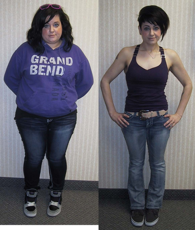 23 Year old woman before removal of LapBAND with conversion to Sleeve Gastrectomy - Before and 11 months after photos of a woman who had struggled with her LapBAND.  It was removed, with one-stage laparoscopic conversion to sleeve gastrectomy.&nbsp;