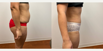 35-44 year old woman treated with Tummy Tuck - 1 Month after an abdominoplasty with muscle tightening.