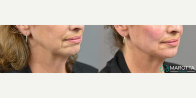 Woman treated with Dermal Fillers, Juvederm, Voluma - A Volume Lift is similar to a liquid facelift because only dermal fillers are used to achieve the desired result. Our goal with Volume Lift is to restore the youthful V shape and contour of the face by strategically, artfully and uniquely placing multiple syringes of filler using the same technique Dr. Marotta uses during a fat transfer procedure. The amount of filler needed to achieve the desired results is determined by your provider.Here is a patient who desired a more defined jawline but wasnt quite ready for surgical intervention. Our nurse injector was able to add visible contour and definition with multiple syringes of Juvederm Voluma to the cheeks, mandibular angle, pre-jowl sulcus and chin. After photo shown is immediately after injection.
