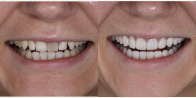 35-44 year old woman treated with Porcelain Veneers, Lumineers - woman treated with Porcelain Veneers