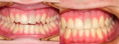 20 year old male with an anterior open bite - 
	Anterior open bite corrected using Damon Self Ligation System. Total active treatment time 14 months. Life long retention.

