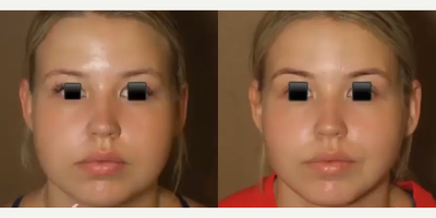 Woman treated with Chin Liposuction - Woman treated with Chin Liposuction