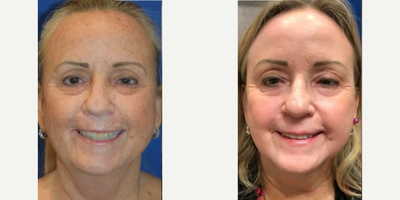 55-64 year old woman treated with Renuvion - Before and After: Renuvion Skin Resurfacing