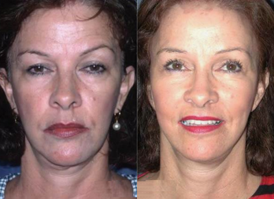 Woman treated with Facelift - Woman treated with Facelift
