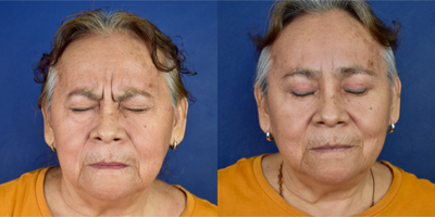 65-74 year old woman treated with Brow Lift, Eyelid Retraction Repair, Facial Fat Transfer - This female patient was concerned about her facial expression; she said she looked tired and worn out. She was concerned about her upper eyelid lateral hooding and hate her lower eyebags. I performed an endoscopic brow lift (Endobrow), upper blepharoplasty, facial fat grafting, lower blepharoplasty (transcutaneous and transconjuctival approach) and Endoscopic forehead lift and mid facelift and facial fat grafting with micro and nano fat. Now, after her periorbital rejuvenation she looks very natural refreshment expression and youthful appeareance.