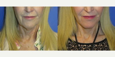 65-74 year old woman treated with Lower Face Lift - 65 year old female seeking rejuvenation of her lower face and specifically jowls, jawline, and neck. She was also treated with CO2 laser around the mouth. She had a lower face and neck lift under local anesthesia and oral sedation.