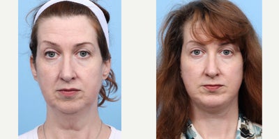 45-54 year old woman treated with Chin Implant, Deep Plane Facelift - This patient was complaining of excess skin, skin laxity, and a recessed chin. Dr. Wise performed a deep plane facelift and chin augmentation to achieve the results she requested.