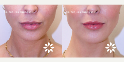 35-44 year old woman treated with Chin Fillers - This Vancouver patient received a chin augmentation treatment with dermal filler injections at 8 West Clinic by Advanced Aesthetic Nurse Injector Lisa Roberge. The treatment restored volume in her lower face, where she was noticing an age-related drop in her chin area, as evidenced by the shadowing around her lower lip and increased amount of lower teeth found showing when she would smile. The result is a fuller lower face region with shadowing eliminated, less of a toothy smile, and softened marionette lines.