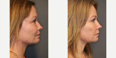 Upper and Lower Eyelid Surgery - Upper and lower eyelid surgery with laser.
