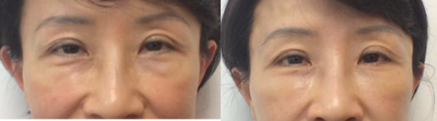 45-54 year old woman treated with Eyelid Surgery - This woman had lower lid bags and demarcations. We treated this with lower lid transconjunctival (hidden incision) eyelid surgery as well as fat transfer.&nbsp;