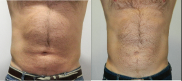 35-44 year old man treated with i-Lipo and Carboxytherapy - 12 sessions of iLipo plus 12 sessions of carboxytherapy