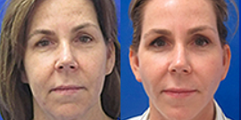 45-54 year old woman treated with TCA Peel - Patient felt that her sundamage etc made her skin look dull.