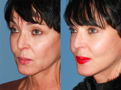Mini Lift - Patient of Dr. Konstantin underwent a face and neck Mini Lift.