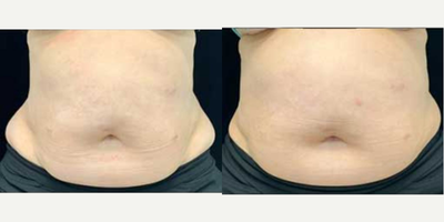 Woman treated with truSculpt - Woman treated with truSculpt.