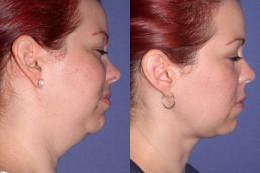 Liposuction - 
	Liposuction is done on an outpatient basis. General anesthesia is usually used for safety and comfort. Small suction tubes (cannulas) are inserted through very short incisions placed in inconspicuous locations near the fat deposits, and excess fat is removed. If large volumes of fat are to be removed, we will probably ask you to donate one or two units of blood and take supplemental iron before surgery. Your own blood will be used as a transfusion at the end of surgery.
