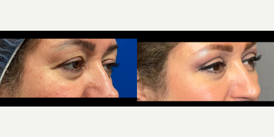 Bilateral Upper Blepharoplasty - This procedure is one of the top cosmetic surgical procedures.Also known as an eyelid Lift, this is the removal of extra skin that accumulates due to aging, gravity and loss of elasticity. It is very often a need. Vision obstruction is eliminated.