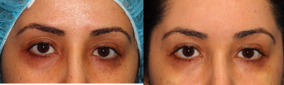 18-24 year old woman treated with PicoSure - 24 year old 3 weeks post - PicoSure laser treatment