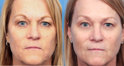 55-60 year old woman treated with Silhouette InstaLift - After photo showing results of 3 threads per side for midface lift