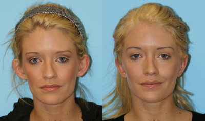 Otoplasty - 
	This patient came in complaining about her ears sticking out. This was a result of having large cartilages that make up the bowl of the ear as well as poorly defined structures of the top of the cartilage, leading to a floppy ear. Dr. Balikian performed an Otoplasty to treat both causes of the protruding ear. The result is a naturally pinned back ear.
