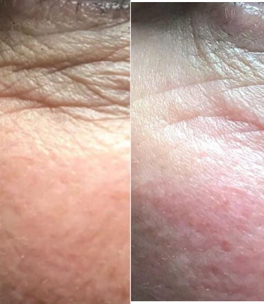 45-54 year old woman treated with TempSure Envi - One Treatment of TempSure Envi