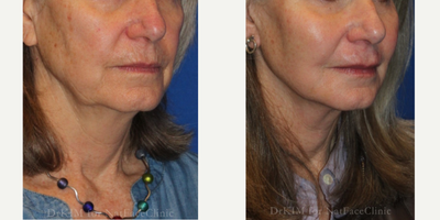 55-64 year old woman treated with Facial Fat Transfer, Restylane, Nonsurgical Facelift - Patient had a Mid Face Fat Transfer from abdomen to bilateral cheeks and bilateral Marionette lines. She also had Restylane filler to her perioral area.
