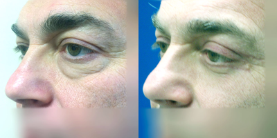 45-54 year old woman treated with Eyelid Surgery - Upper and Lower eyelid lift (quad-lid blepharoplasty). Eye bags are one of the first signs of aging, making an eyelid lift one of the first procedures people interested in facial rejuvenation seek.