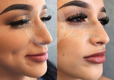 Woman treated with Injectable Fillers - Woman treated with Injectable Fillers