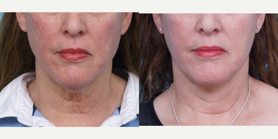 55-64 year old woman treated with Neck Lift - This patient was bothered by her neck. Dr. Balikian preformed a neck lift with some liposuction.