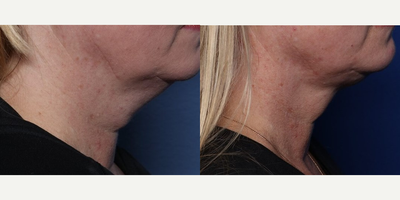 51 year old woman treated with FaceTite, Morpheus8, Microneedling - 51 year old woman treated with FaceTite, Morpheus8, Microneedling