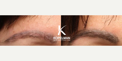 25-34 year old woman treated with Eyebrow Transplant - Age: 28Gender: FemaleProcedure: Eyebrow Hair TransplantGrafts: 450Procedure Description: The patient aimed to correct sparse areas for a more natural look. Photos taken before and nine months after the procedure.