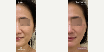 45-54 year old woman treated with Ultherapy - Mid 40s woman treated with Ultherapy for Full Face & Neck