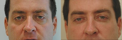 Restylane for Dark Circles Under the Eyes - 
	Restylane for dark circles under the eyes. 2 CC's of Restylane for under eye injections with approximately 1 year duration.
