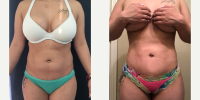 25-34 year old woman treated with Liposuction - Beautiful post op results in this 32 year old patient from Denver, Colorado two months after 360 liposuction and Brazilian butt lift with Premium Care. Surgical time was 2.5 hours using two plastic surgeons, and she spent one week after surgery recovering in Cartagena at our five star Recovery Suites. Her figure looks amazing!