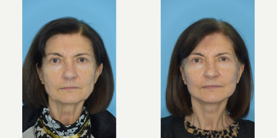 73 year old female, one month out from deep place face and neck lift - 73 year old female, one month out from deep place face and neck lift