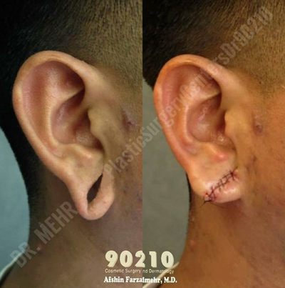 Man treated with Earlobe Surgery - Man treated with Earlobe Surgery to close stretched ears