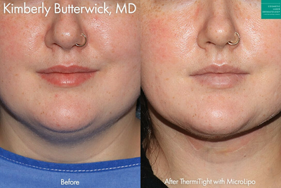 Woman treated with ThermiTight - ThermiTight with MicroLipo to contour the chin, jawline, and neck by Dr. Butterwick