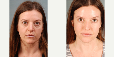 35-44 year old woman treated with Fat Transfer - Facial fat graft performed to lower lid-cheek junction, lateral cheek, tear trough, nasolabial crease, marionette lines and pre jowl jaw line.  This restores the deflated cheek volume and blends the lid cheek junction providing a more rested and youthful appearance