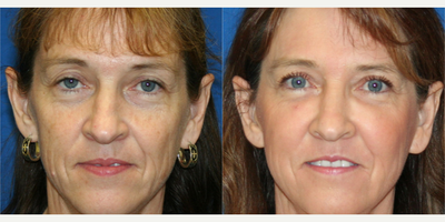 55-64 year old woman treated with Non Surgical Face Lift - 55 year old woman treated with Non Surgical Face Lift